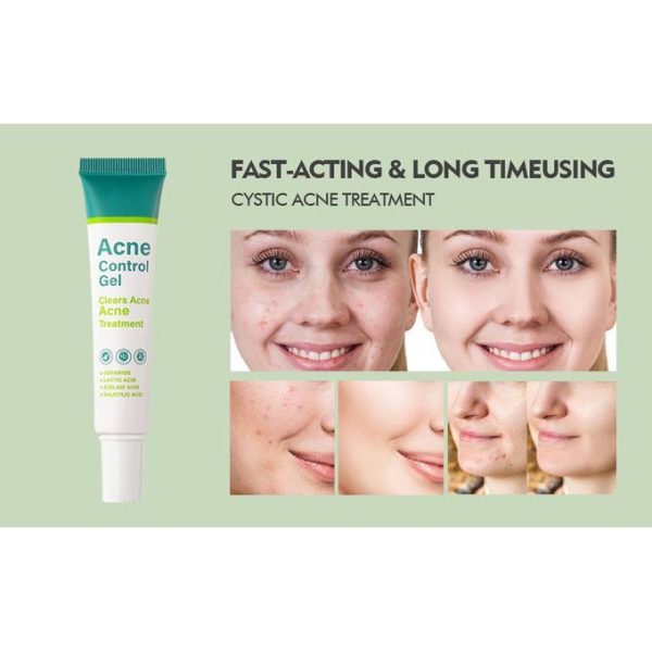 Tube of Advanced Acne Solution-ACNE Face Cream for spot treatment and acne care, lightweight anti-acne formula sold by Elomart in Nigeria